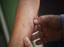Casos de lesões de pele com coceira são notificados em todas as regiões de Pernambuco