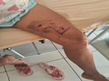 Agricultora é ataca por onça em Carnaubeira da Penha, no Sertão. — Foto: Arquivo pessoal